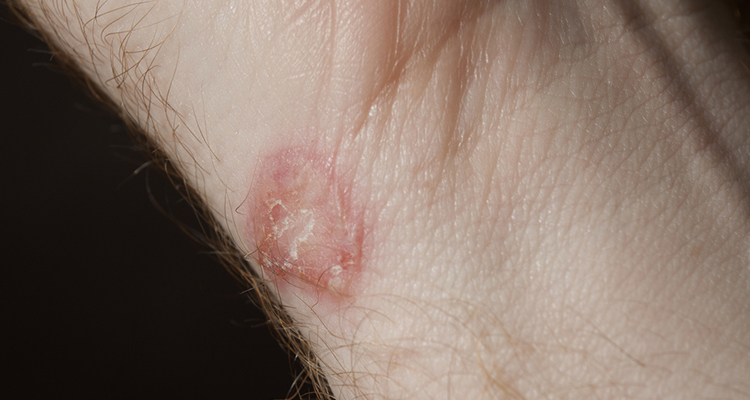 Everything you need to Know about Fungal Skin Infections: Ringworm, Jock Itch and Athlete’s Foot