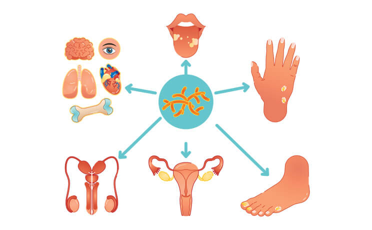 Body Parts Fungal Skin Infection Can Affect