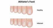 Everything You Want to Know about Fungal Skin Infection – Athlete’s Foot