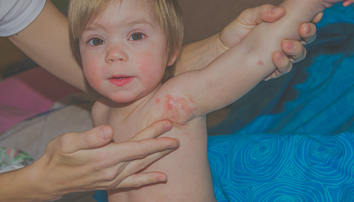 How to Save your Children from Fungal Skin Infections at Home?