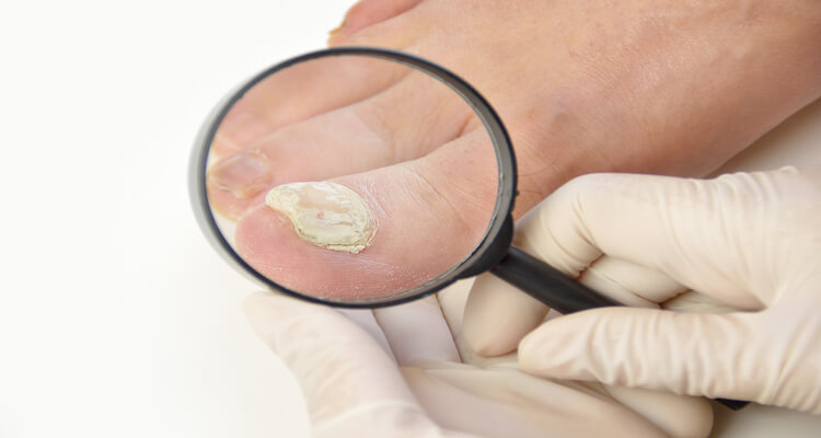 Fungal Nail Infection Can Be Dangerous For Your Health