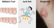 Difference between Ringworm, Jock Itch and Athlete’s Foot