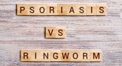 Treatment for ringworm - Psoriasis-vs-Ringworm