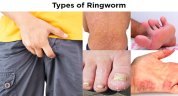 5 Different Kinds of Fungal Skin Infections