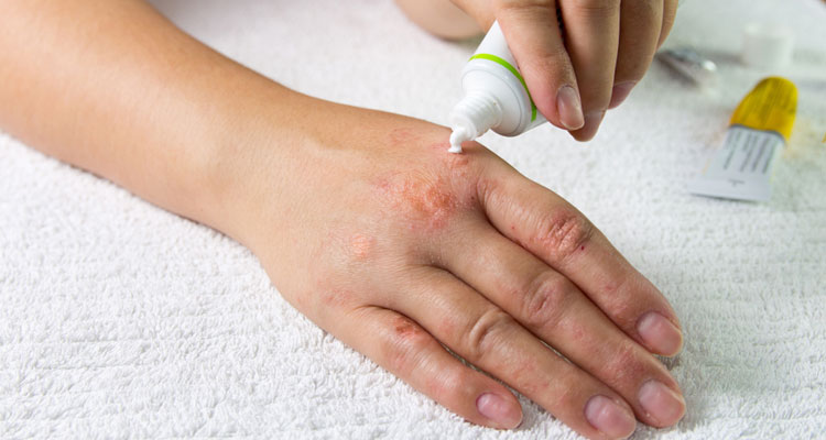 How to use a Ringworm Cream for Effective Treatment of Ringworm?